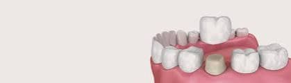 Dental Crowns & Bridges