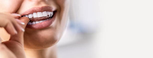 Aligners