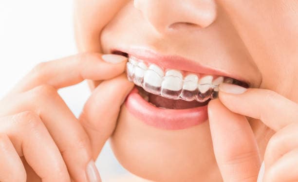 Aligners 2