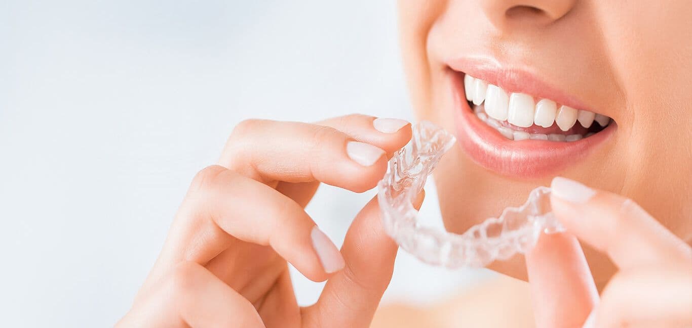 Aligners 1