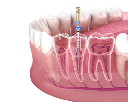 Laser Dentistry