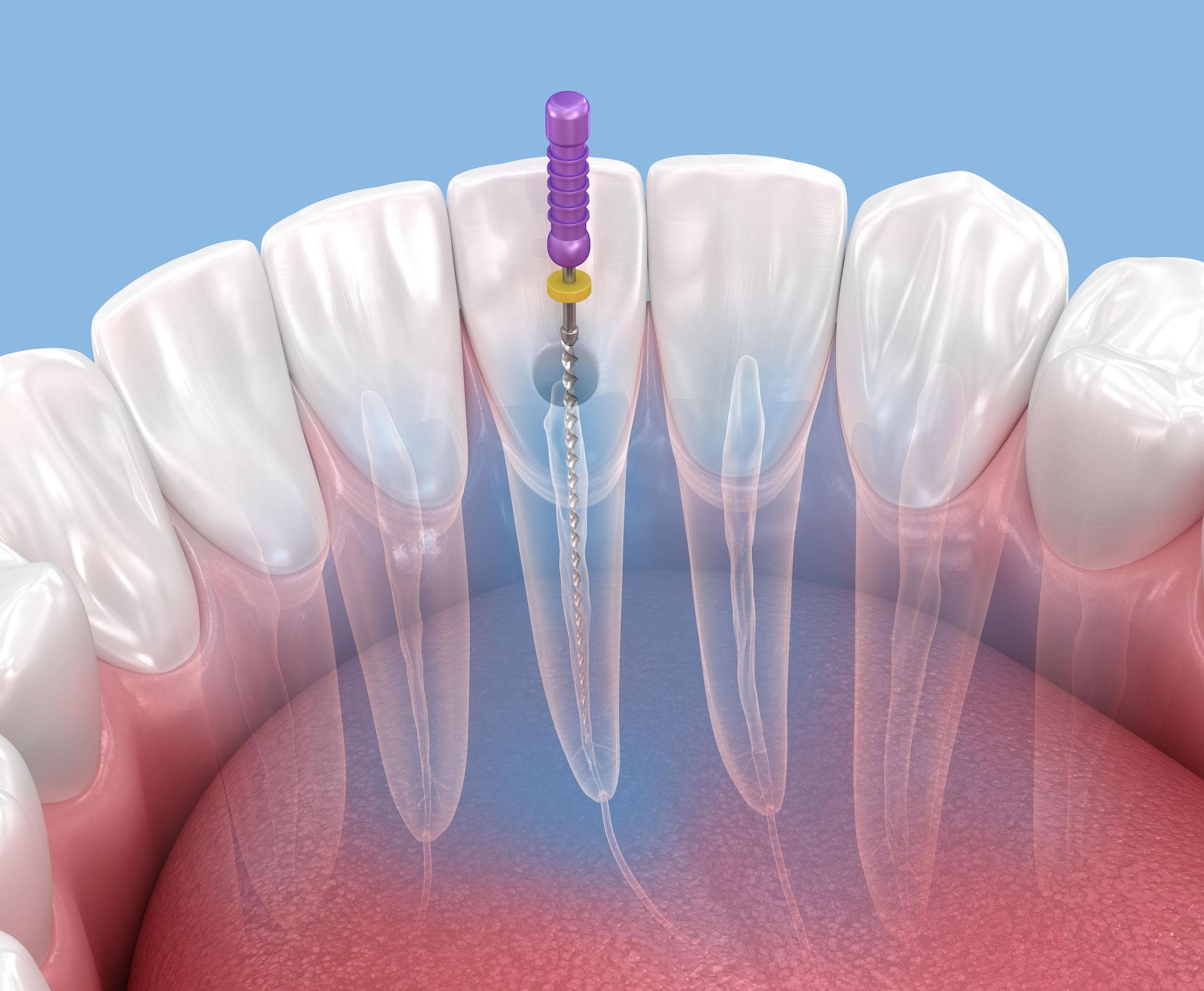 Root Canal Treatment