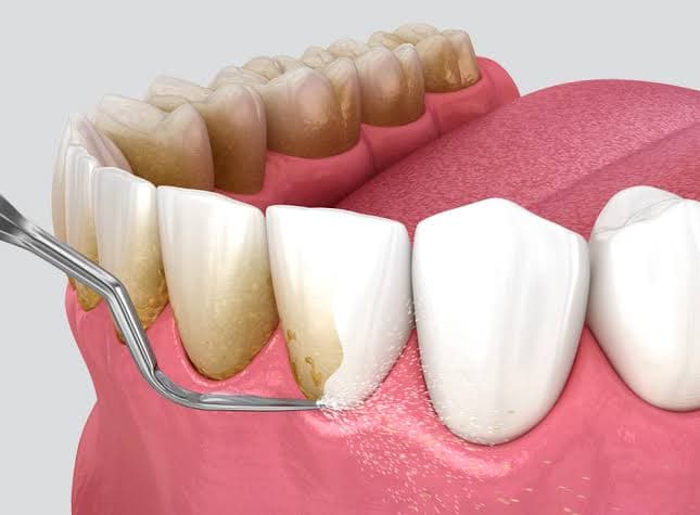 Scaling and Polishing 4