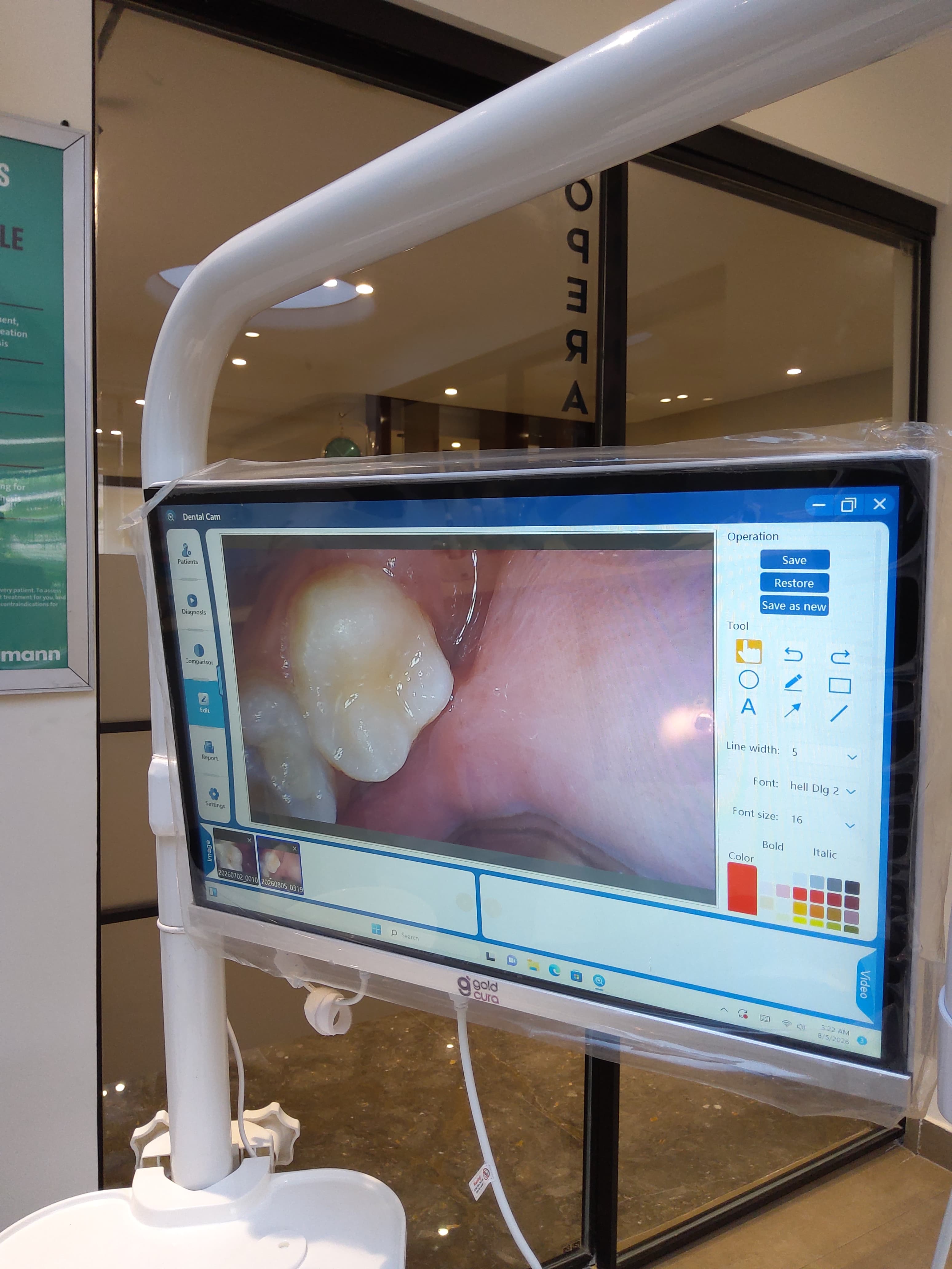 Tooth Colored Fillings 1