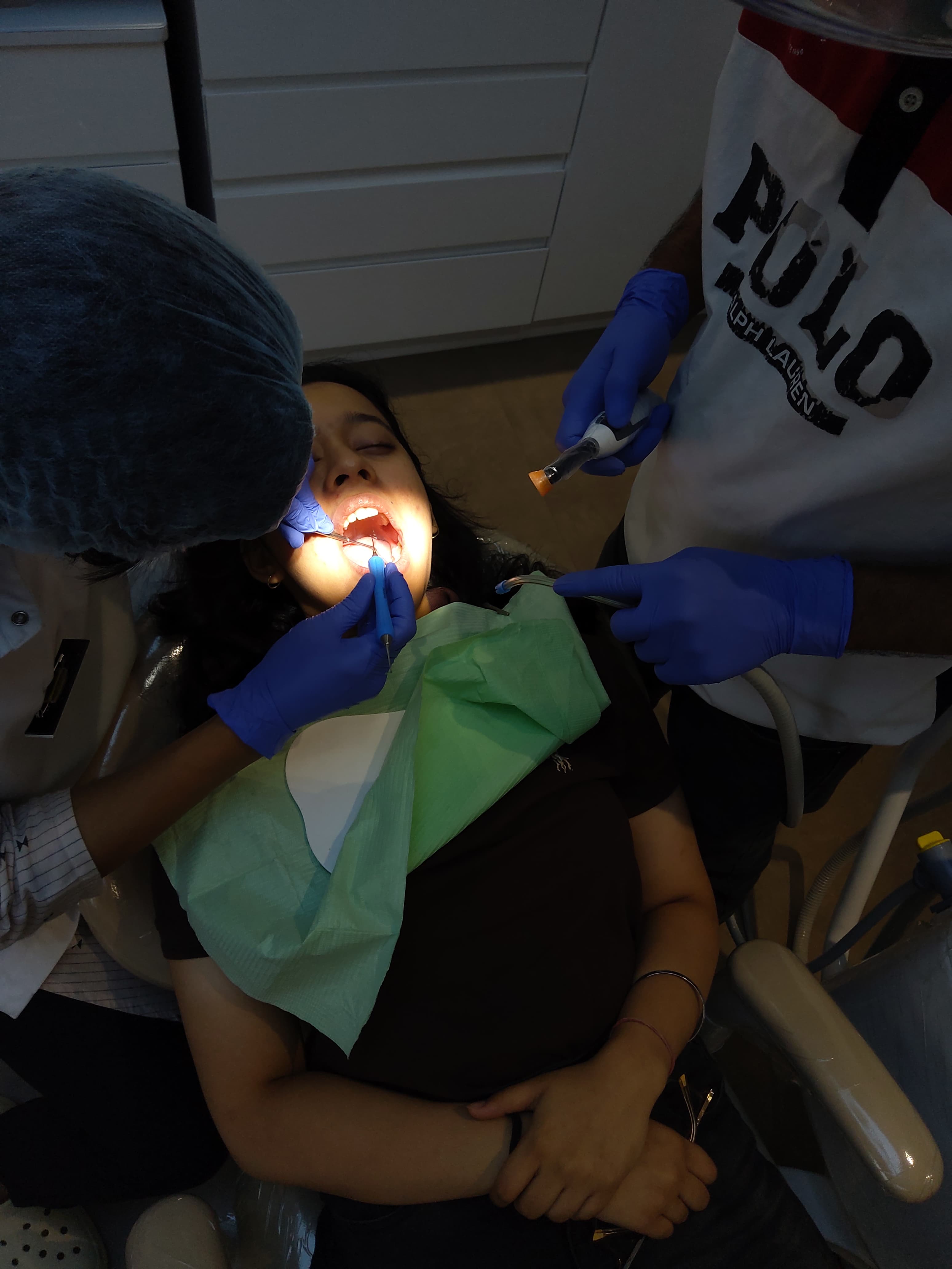 Tooth Colored Fillings 2