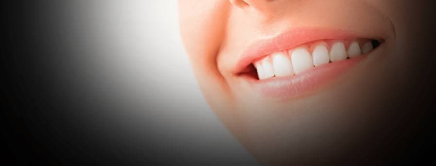 Veneers