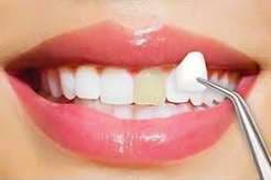 Veneers 1