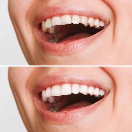 Veneers 2