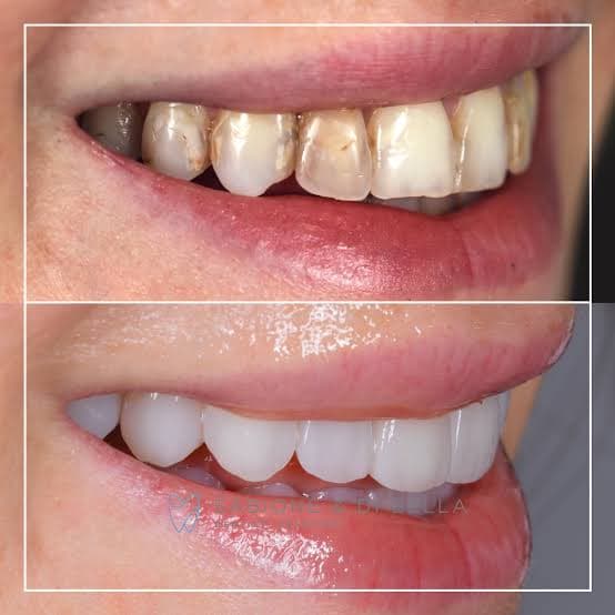Veneers 3