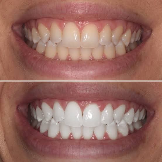 Teeth Whitening 2