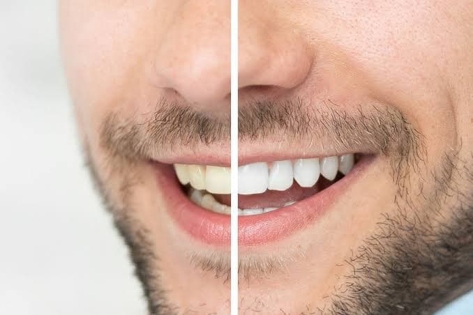 Teeth Whitening 3