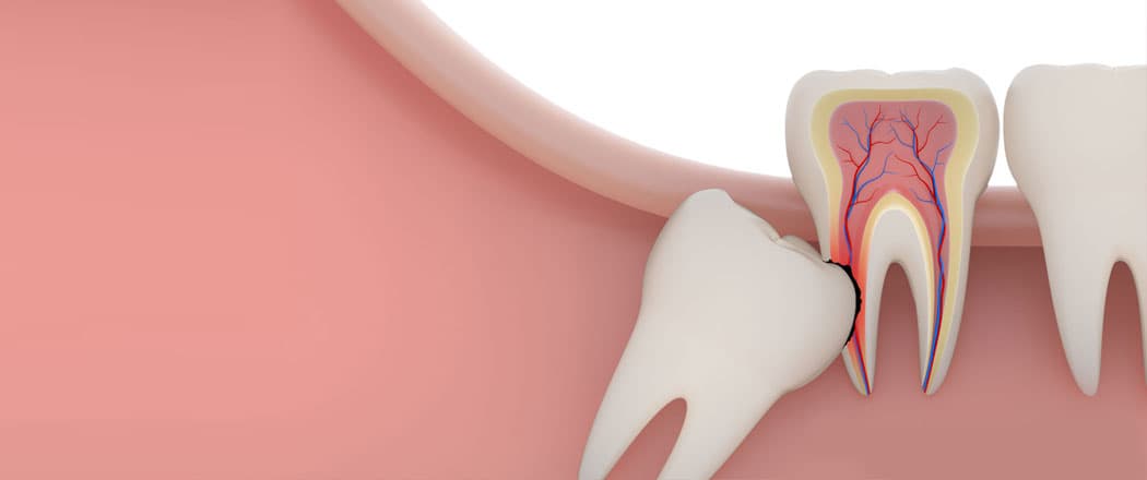 Wisdom Teeth Extraction