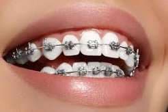 Teeth Braces 1
