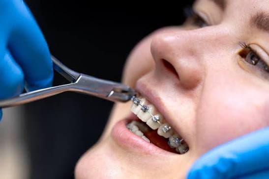 Teeth Braces 2