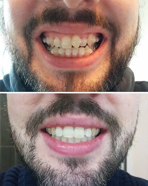 Teeth Braces 3