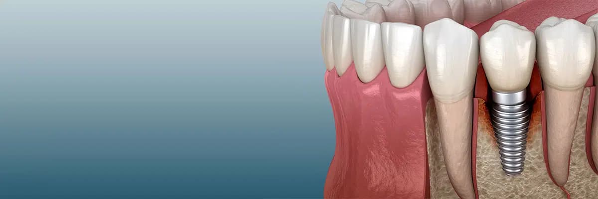 Dental Implant
