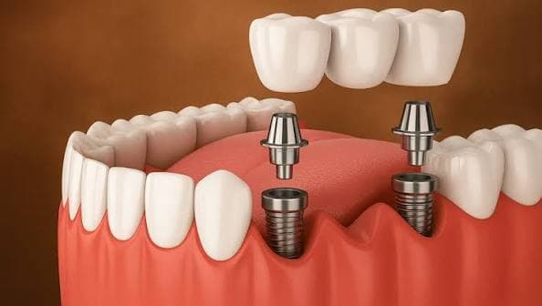 Dental Implant 2
