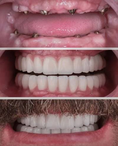Dental Implant 3