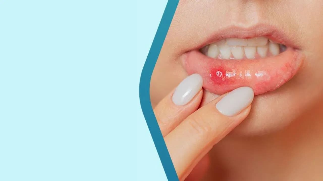 Mouth Ulcers