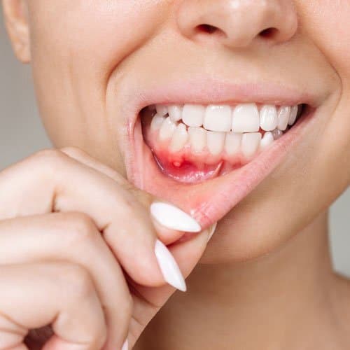 Mouth Ulcers 1