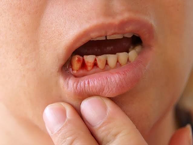 Mouth Ulcers 2