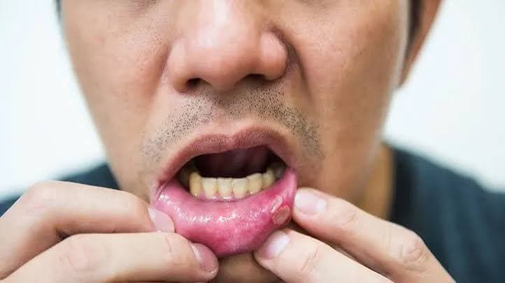 Mouth Ulcers 3